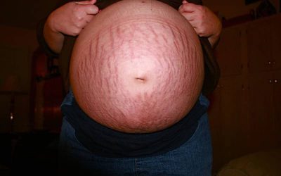Striae voorkomen tijdens de zwangerschap